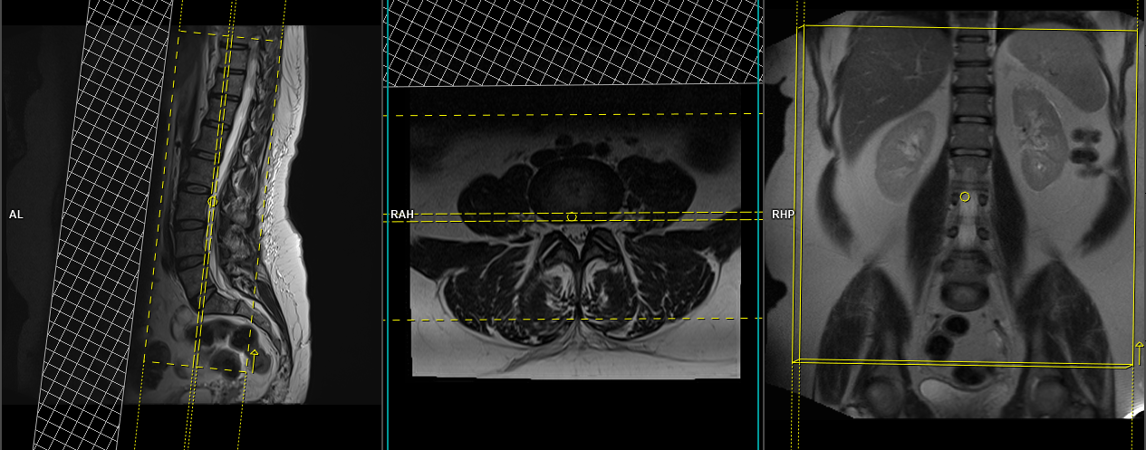 Lumbar Lumbosacral Spine Mri Planning And Protocols Indications For