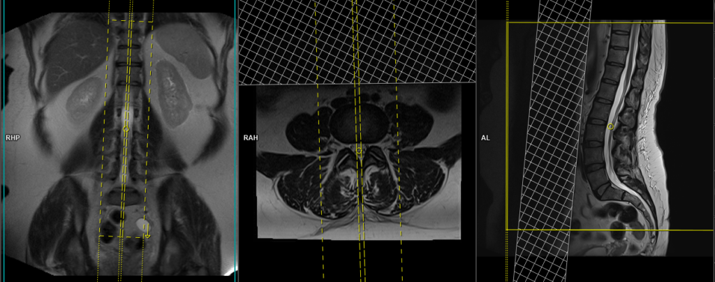 MRI lumbar spine protocol and planning of sagittal scans