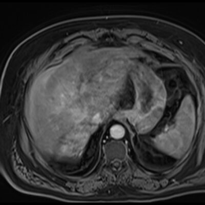 MRI motion artifacts in liver