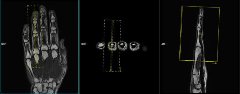 MRI ring finger | MRI ring finger protocol, positioning and planning