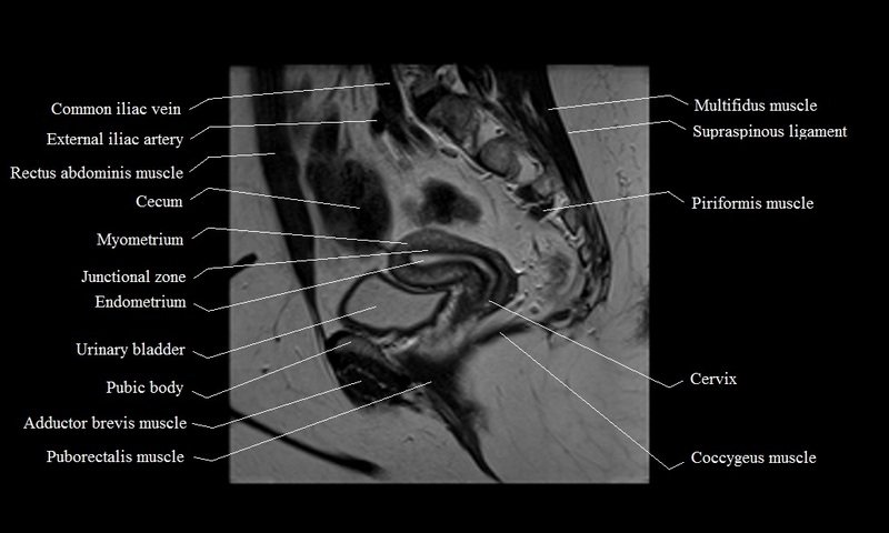 MRI Female Pelvis Anatomy Free MRI Sagittal Cross Sectional Anatomy MRI Female Pelvis Anatomy Free MRI Sagittal Cross Sectional Anatomy