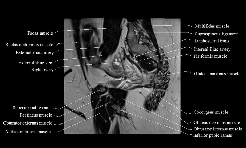 MRI anatomy brain axial image 11