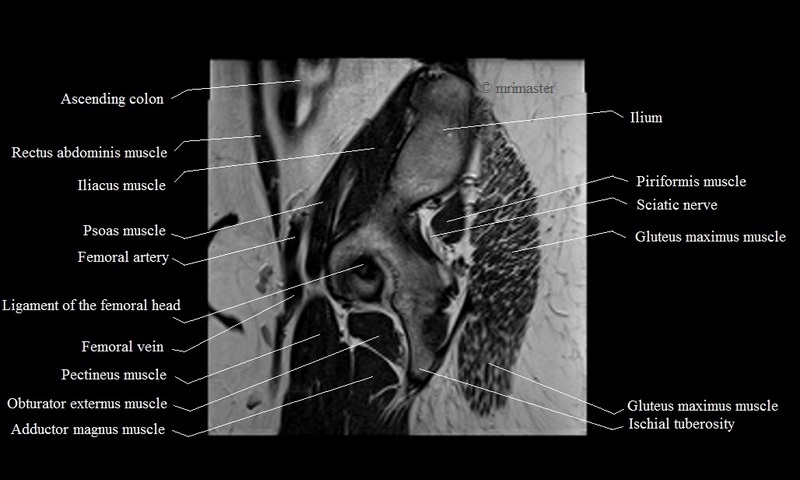 MRI anatomy brain axial image 17