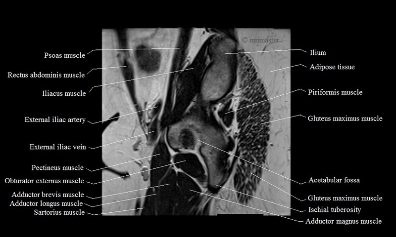 MRI anatomy brain axial image 5