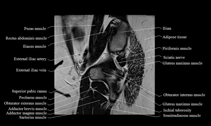MRI anatomy brain axial image 21