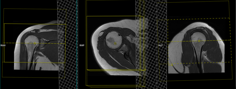 Mri Shoulder Arthrogram Protocols And Planning Indications For Mri 