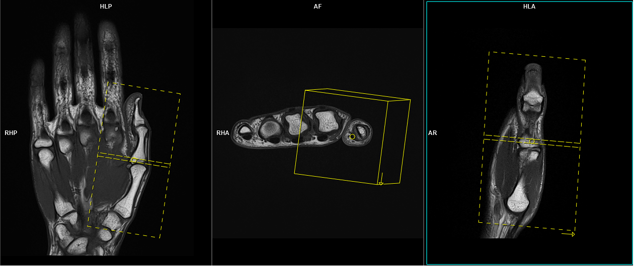 MRI thumb | MRI thumb protocol and planning