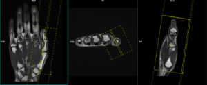 MRI thumb | MRI thumb protocol and planning