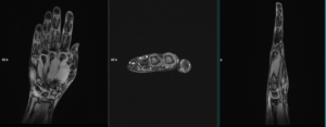 MRI thumb | MRI thumb protocol and planning