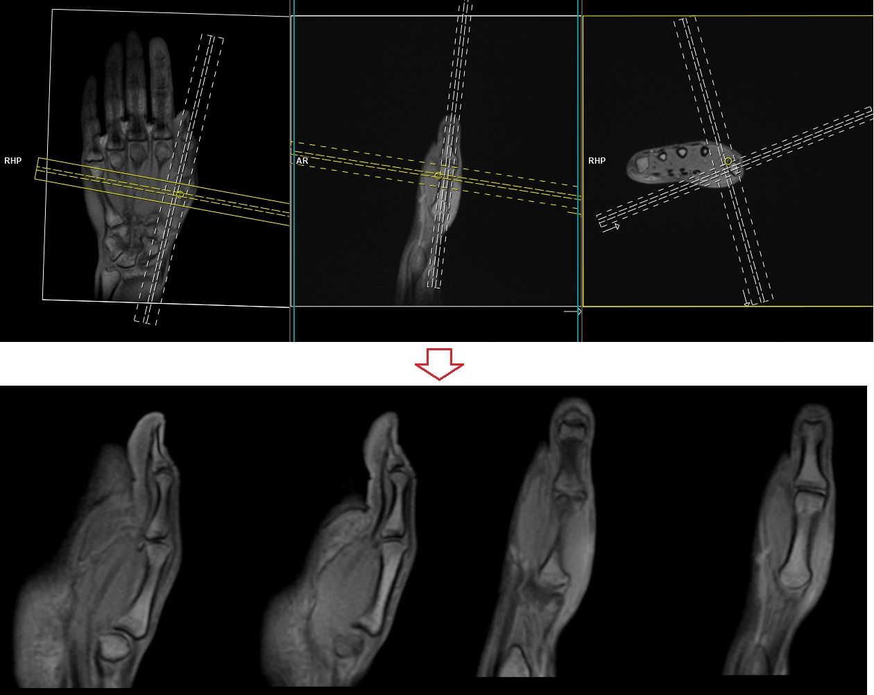 MRI thumb | MRI thumb protocol and planning