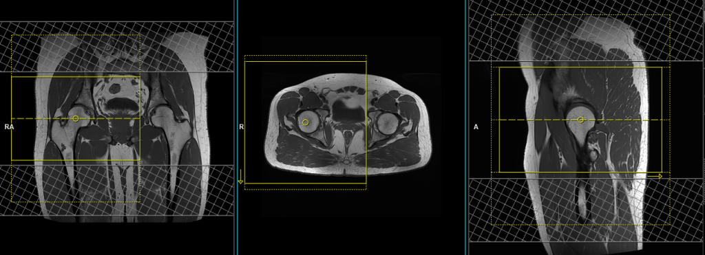 MRI unilateral hip arthrogramplanning of axial 3d scans