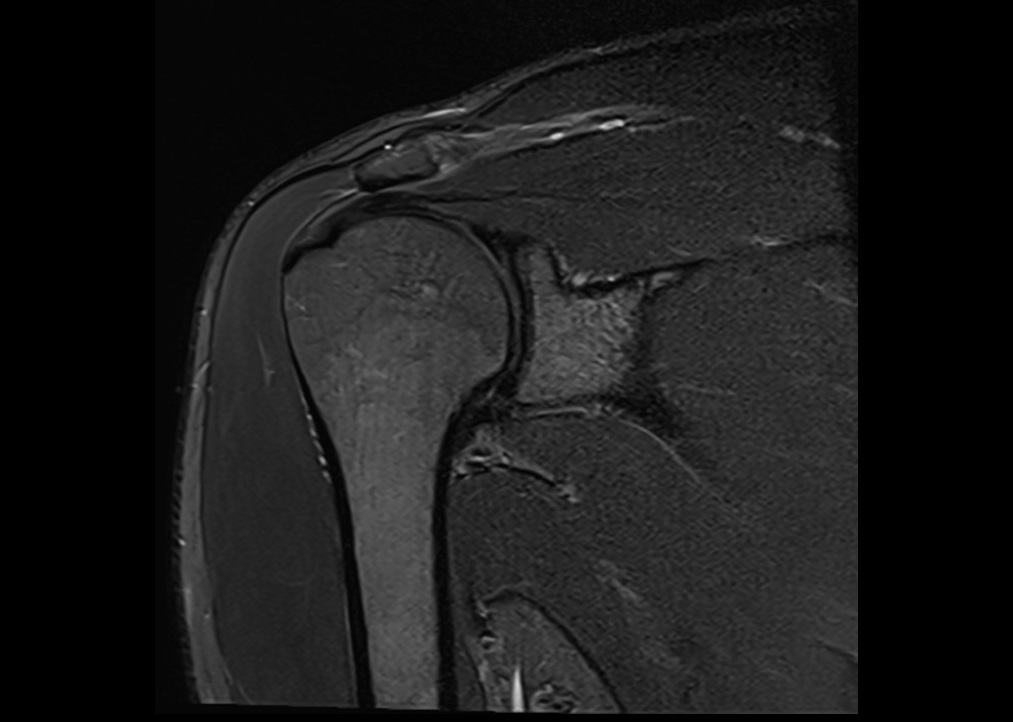 STIR MRI sequence | Physics, pathology and image appearance