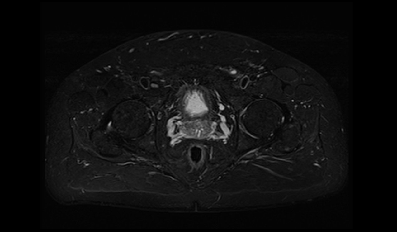 STIR fat saturation image of pelvis 1 STIR fat saturation image of pelvis 1