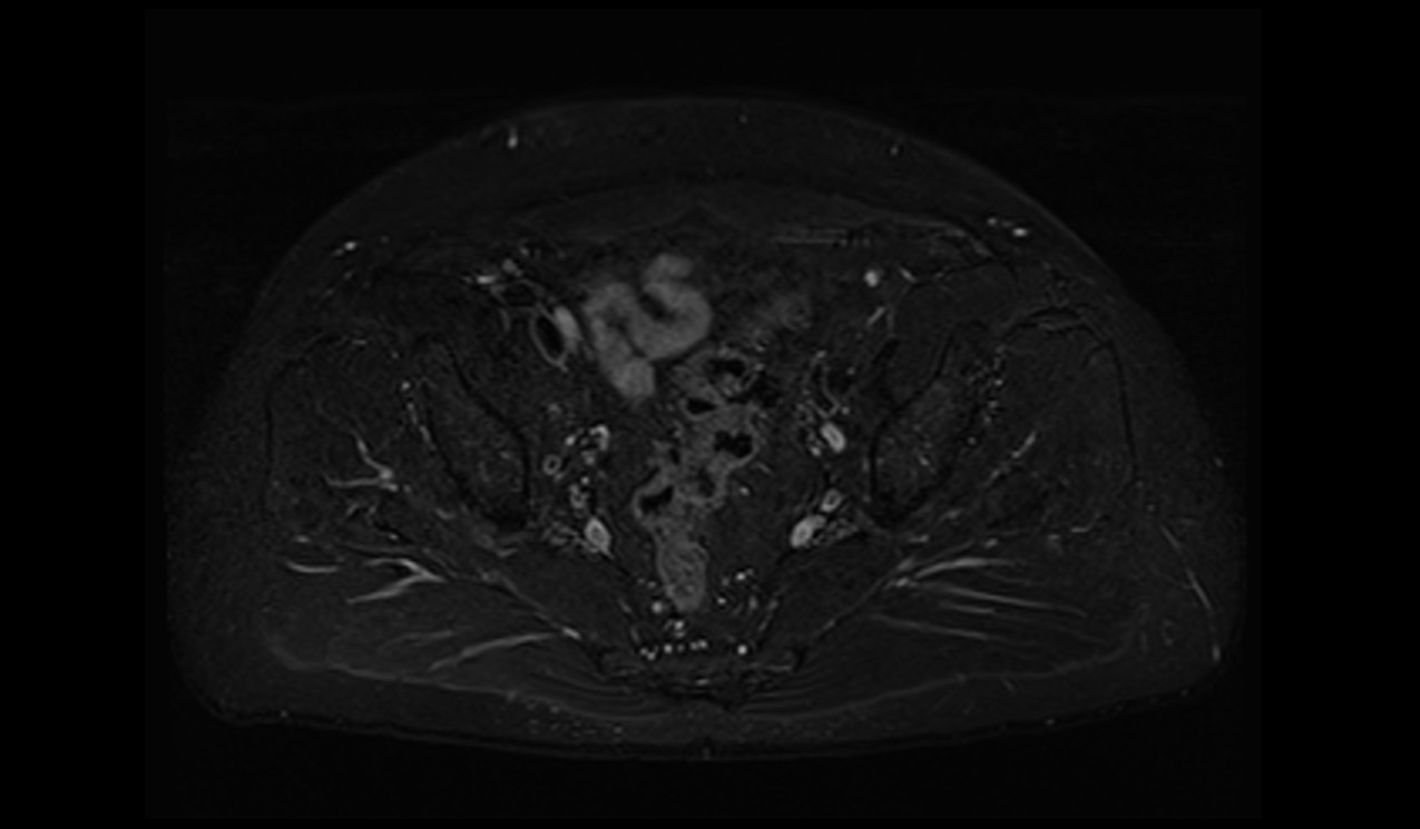 MRI fat saturation | MRI fat suppression techniques