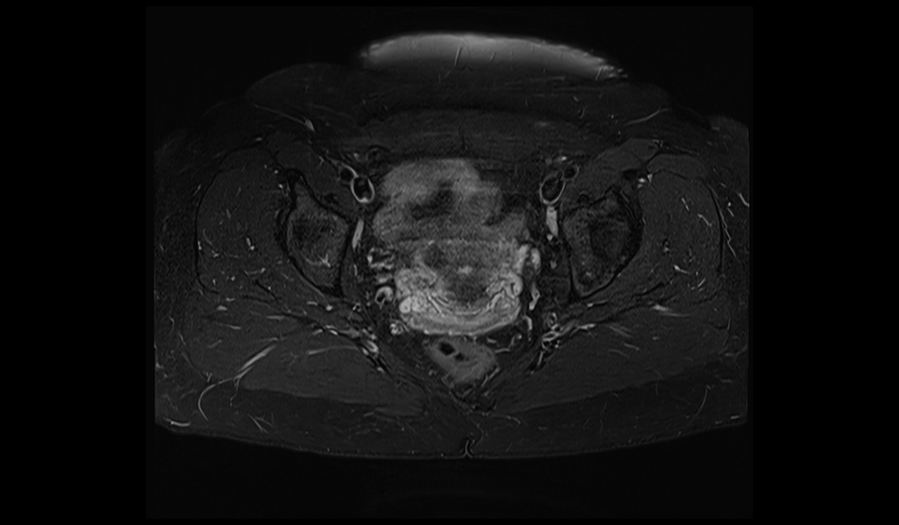 MRI fat saturation | MRI fat suppression techniques