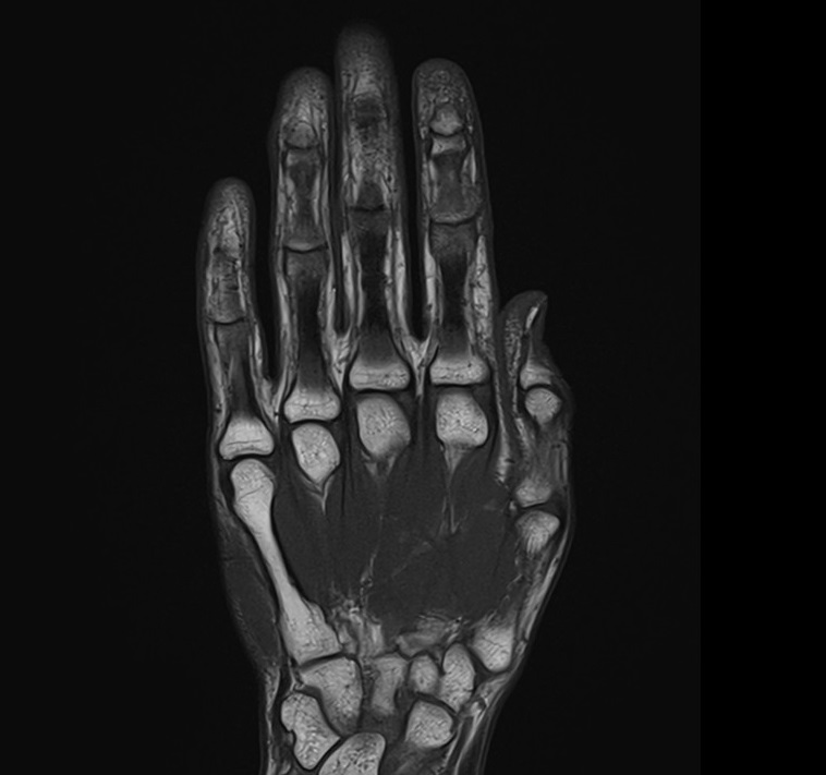 T1-weighted turbo spin-echo coronal image of the hand