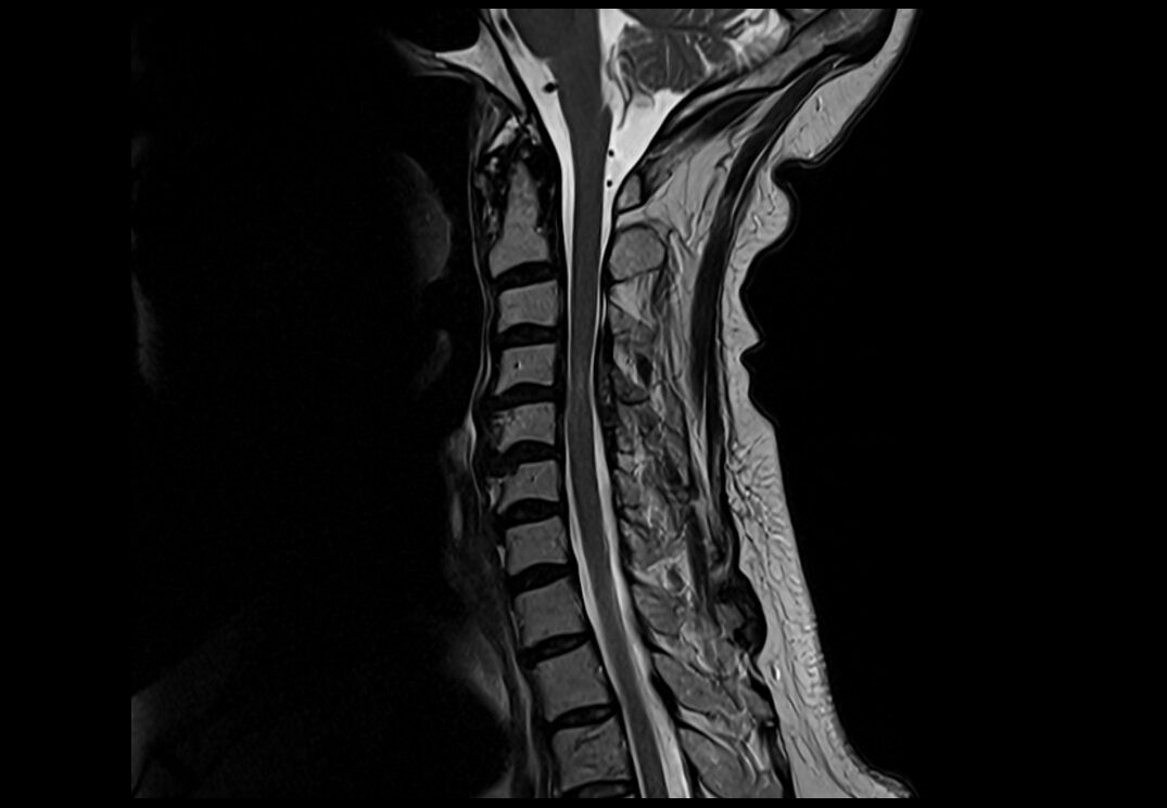 T2 MRI | T2 weighted MRI sequence physics and image appearance