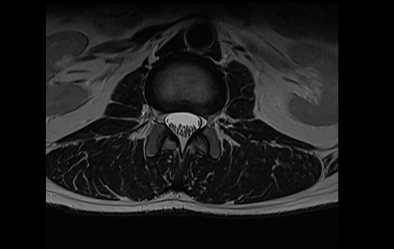 T2 MRI | T2 weighted MRI sequence physics and image appearance