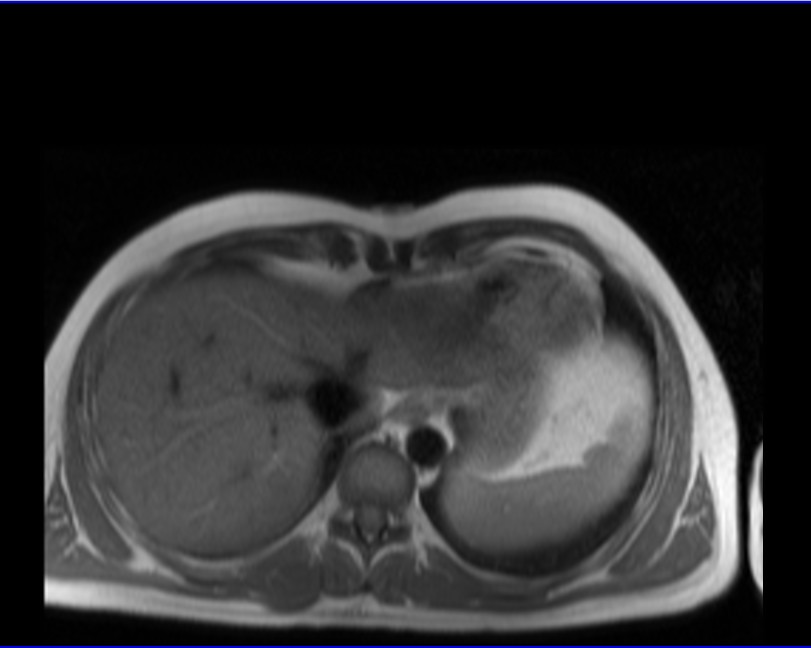cardiac MRI haste dark blood axial  15