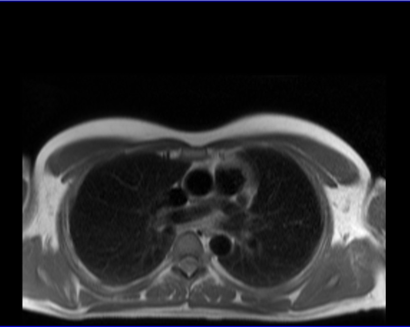 cardiac MRI haste dark blood axial  5