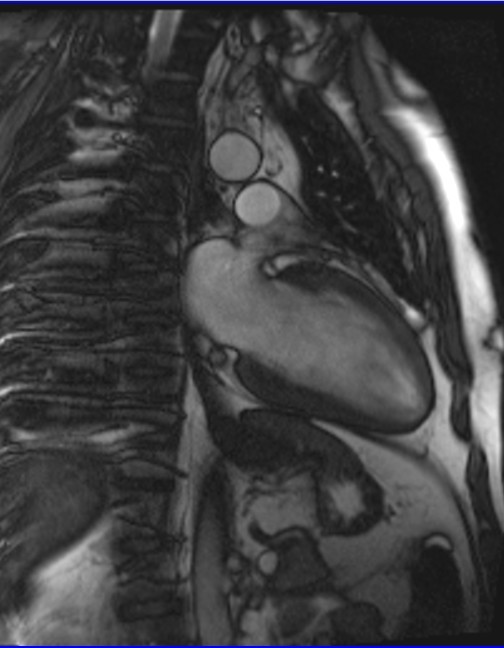 cardiac mri 2 chamber cine image  6