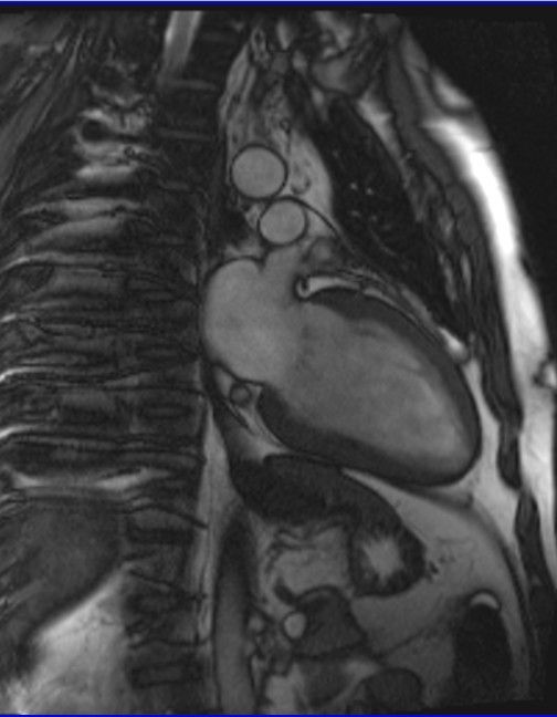 cardiac mri 2 chamber cine image  9