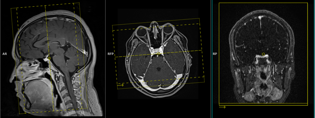 fourth ventricle mri