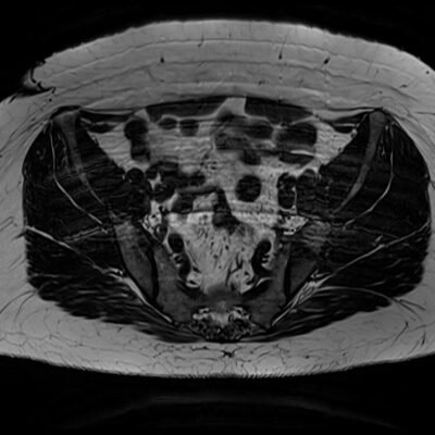 mri motionartifact pelvis