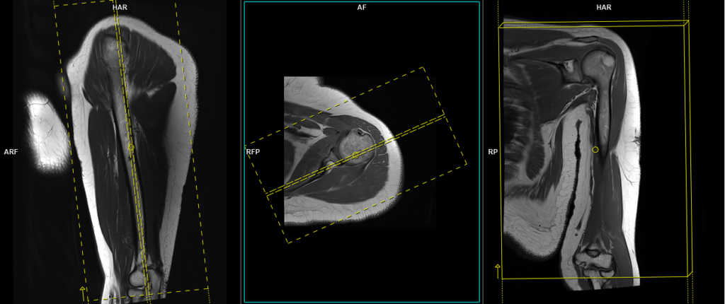 MRI ELBOW JOINT PLANNING AND POSITIONING ON PHILIPS 3T 