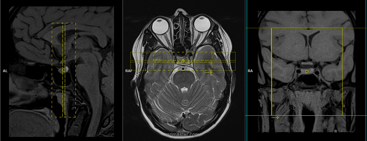 Pituitary Fossa Sella Turcica Mri Planning And Protocols Indications