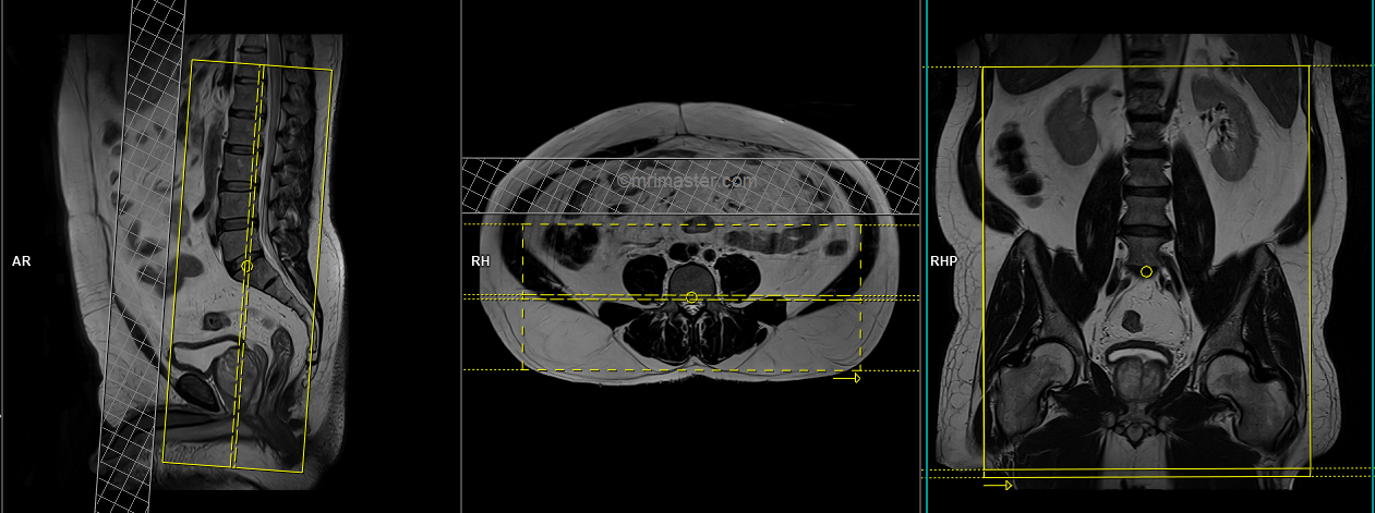 Lumbosacral Plexus MRI Protocols And Planning | Indications For MRI ...