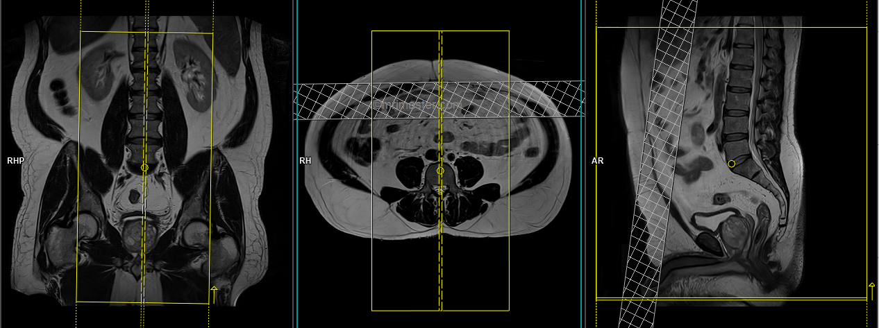 Lumbosacral Plexus Mri Protocols And Planning Indications For Mri