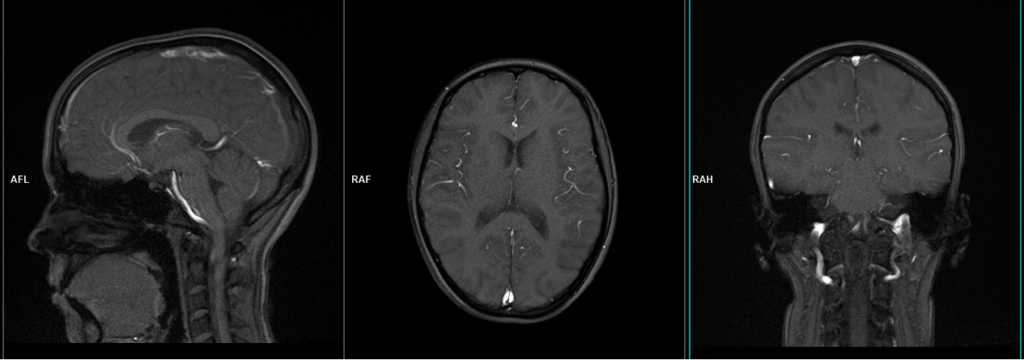 Brain MRA localiser image
