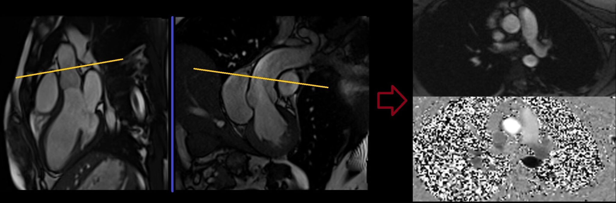 Cardiac MRI Flow Quantification Protocols, Planning and Techniques