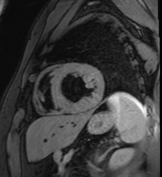Cardiac T1 FS short axis view image