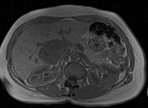 liver hemangioma MRI