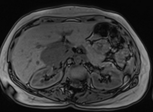 HAEMAGIOMA MRI out of phase