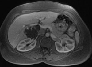 liver hemangioma MRI - mrimaster