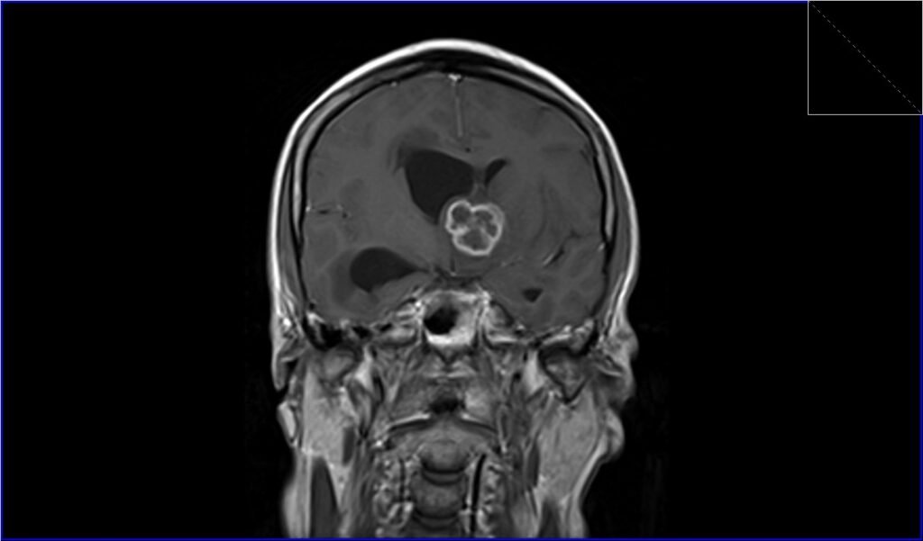 MRI Intracranial tuberculosis (TB) t1 coronal post contrast image