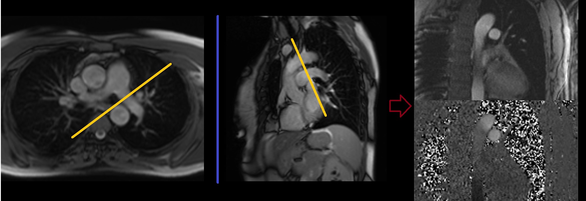 Cardiac MRI Flow Quantification Protocols, Planning and Techniques