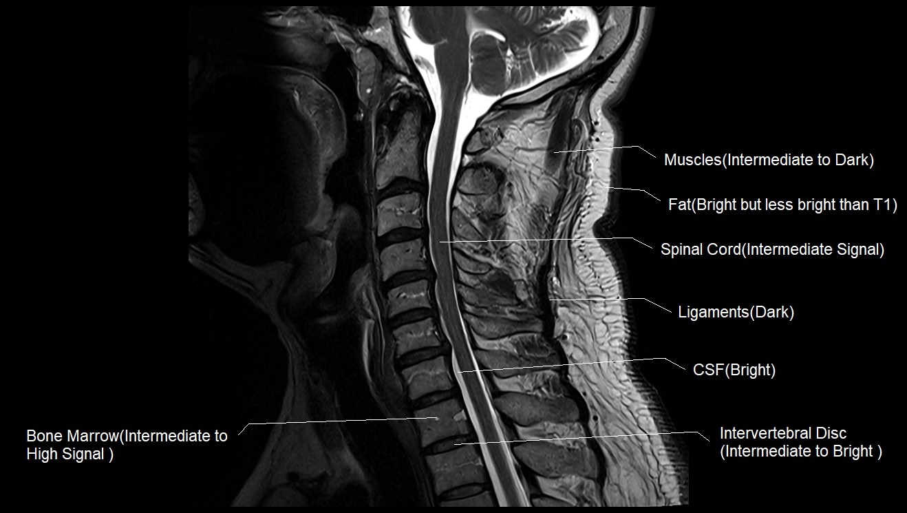 T1 Vs T2 Mri T1and T2 Mri Image Comparison