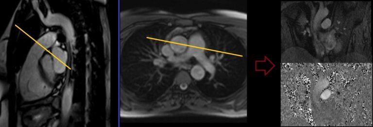 Cardiac MRI Flow Quantification Protocols, Planning and Techniques