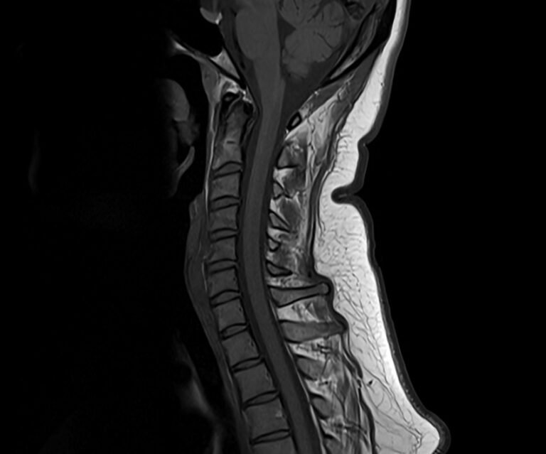 FLAIR MRI FLAIR MRI Sequence Physics Image And Pathology Appearance