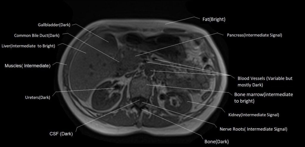 T1 Vs T2 Mri 