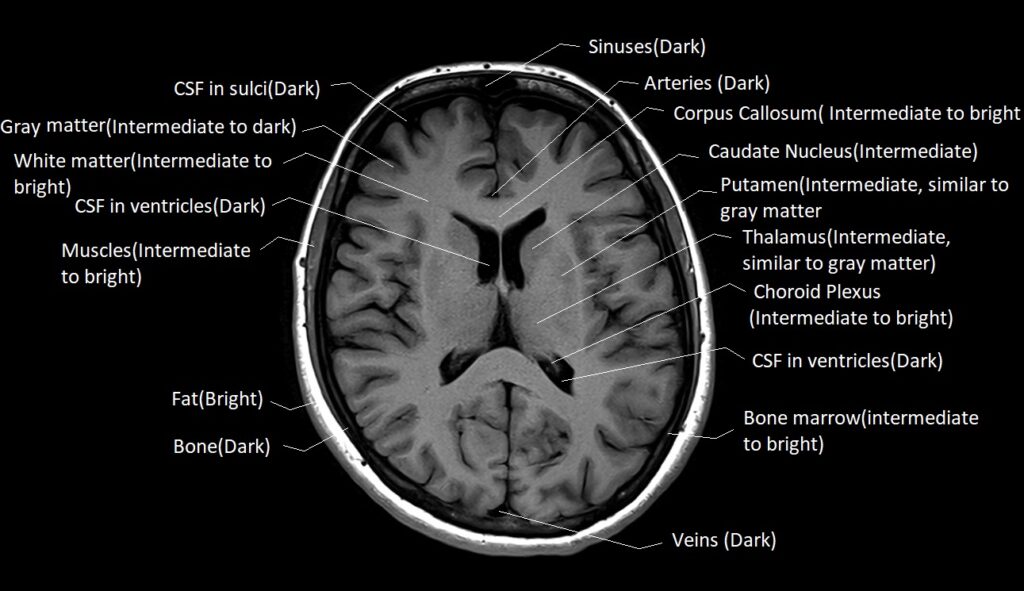 t1-vs-t2-mri-t1and-t2-mri-image-comparison