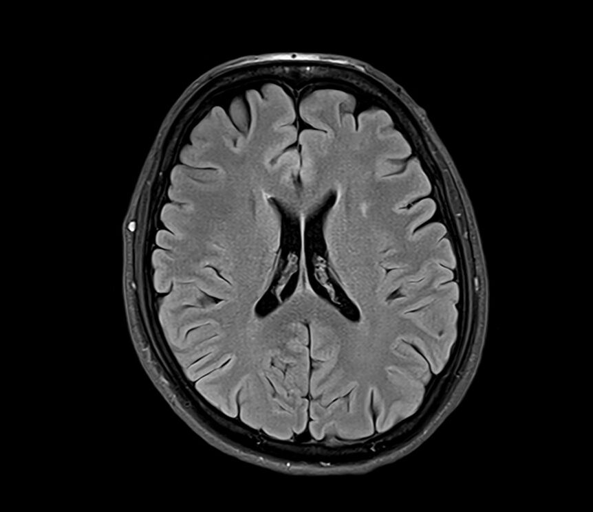 T2 FLAIR image of the brain
