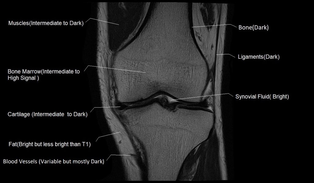 T1 vs T2 MRI | T1and T2 MRI image comparison