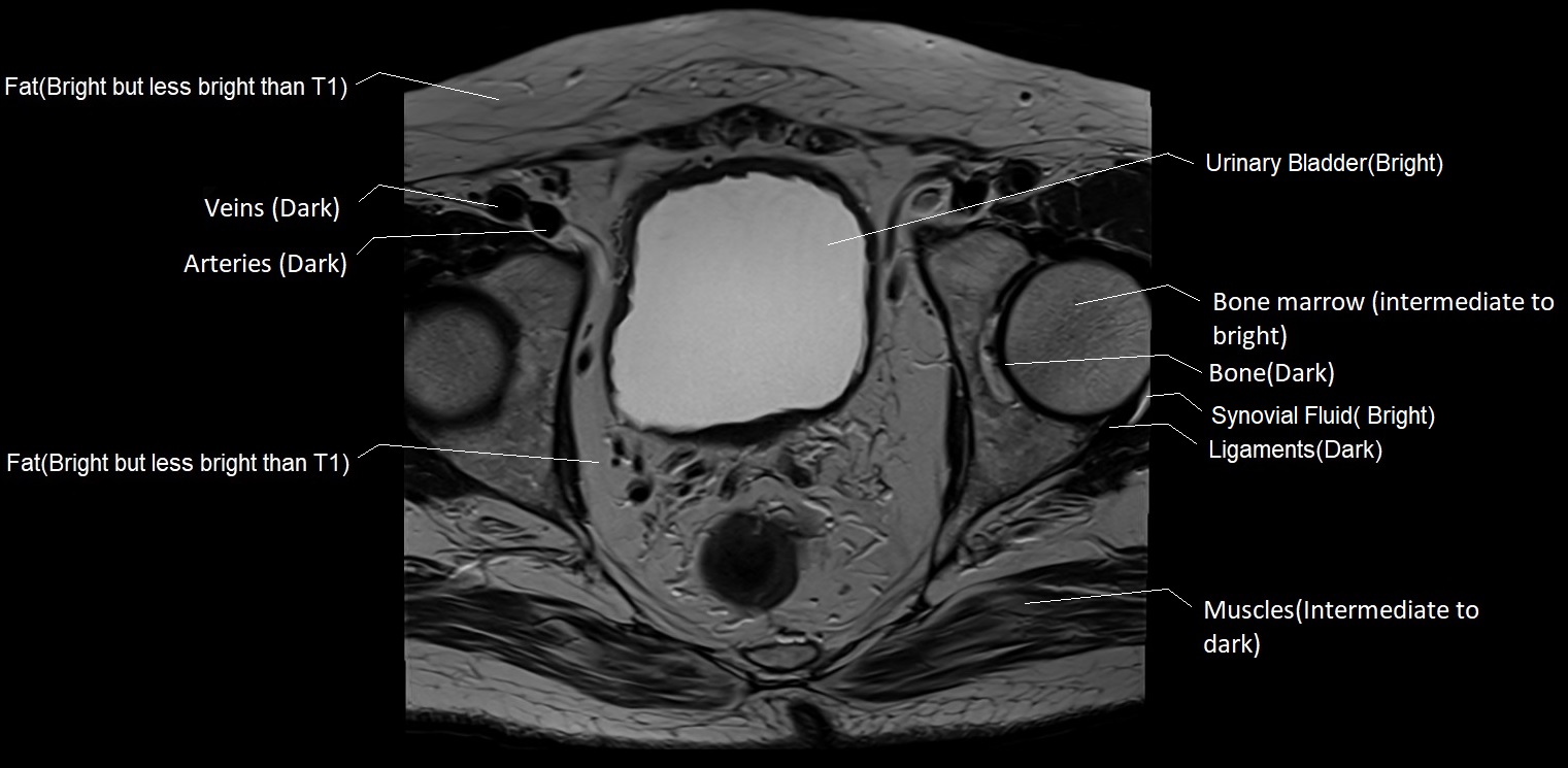 T1 Vs T2 MRI | T1and T2 MRI Image Comparison