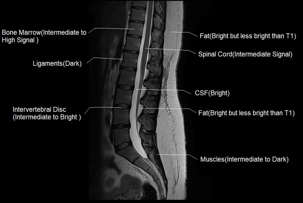 T1 vs T2 MRI | T1and T2 MRI image comparison