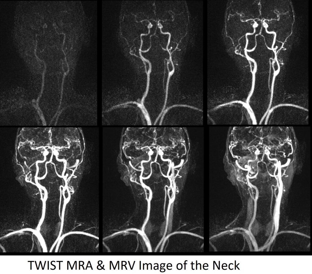 TWIST MRA and MRV image of the Neck